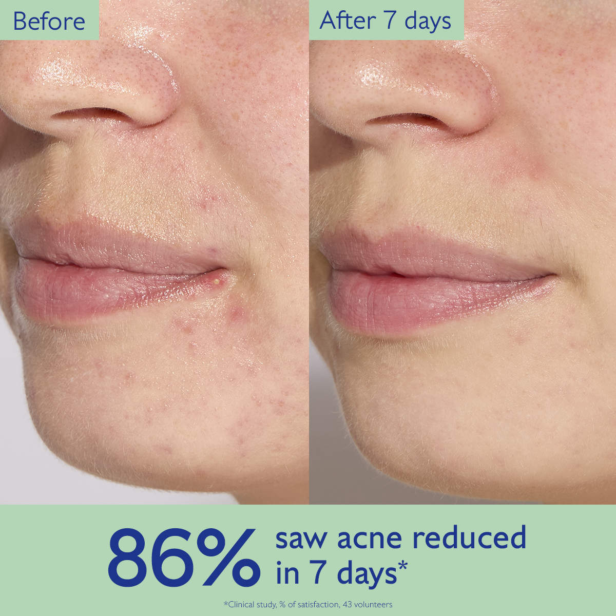 Caudalie  Vinopure Acne Serum to Treat and Prevent Blemishes **BAJO-PEDIDO**