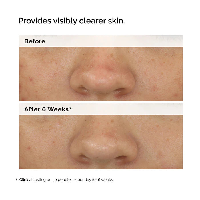 The Ordinary - Balancing & Clarifying Serum for Blemish-Prone Skin