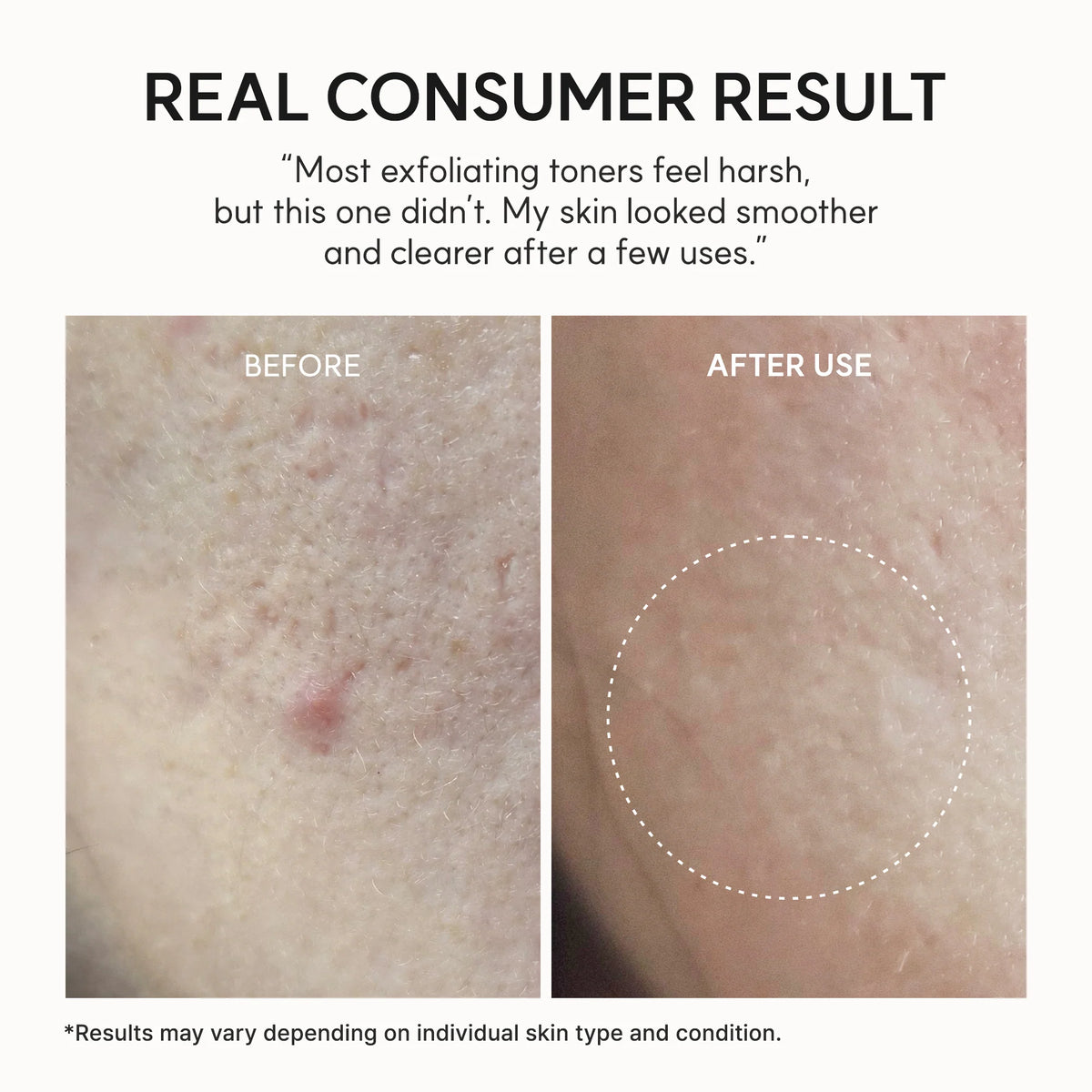 Arencia - Exfoliante Facial Eraser Shot Glycolic Acid Exfoliator