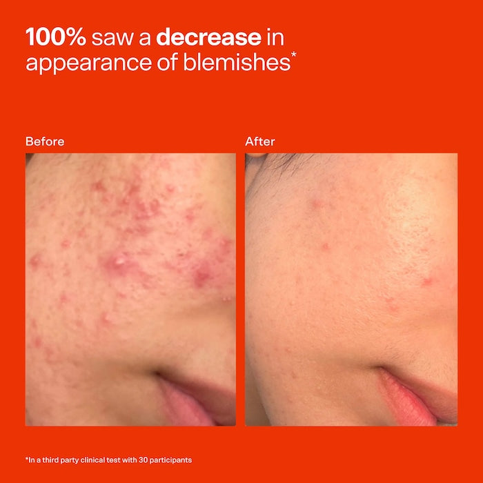 Tower 28 - SOS Daily Hypochlorous Acid Spray for Breakouts & Redness ***Bajo pedido***
