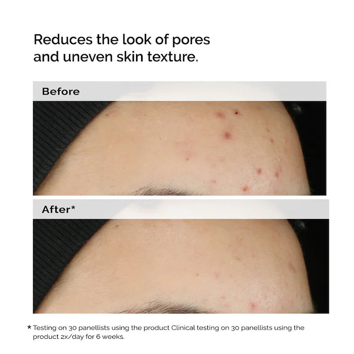 The Ordinary - Balancing & Clarifying Serum for Blemish-Prone Skin