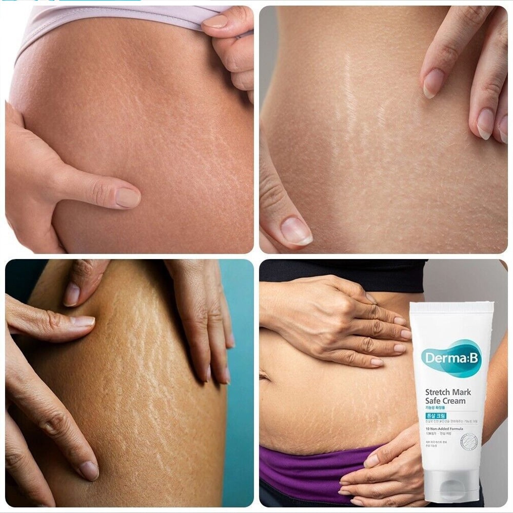 Derma: B - Crema para Estrías Stretch Mark Safe Cream