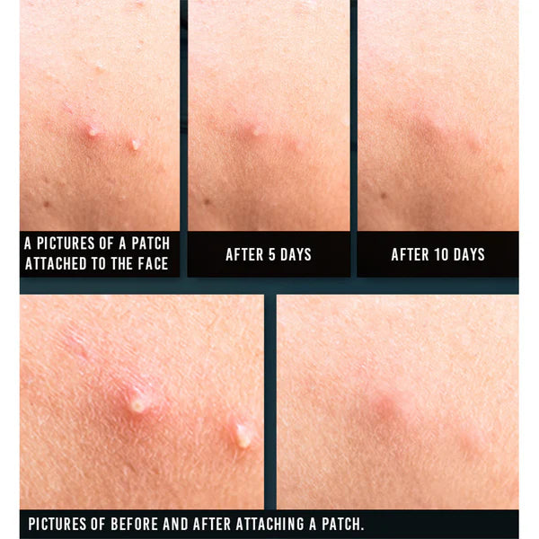 Pyunkang Yul - Acne Spot Patch Super Thin (15 ea)