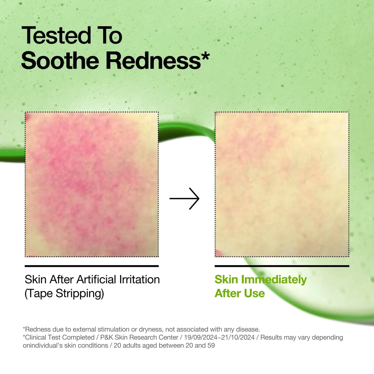 Anua - Azelaic Acid 10+ Hyaluron Redness Soothing Serum